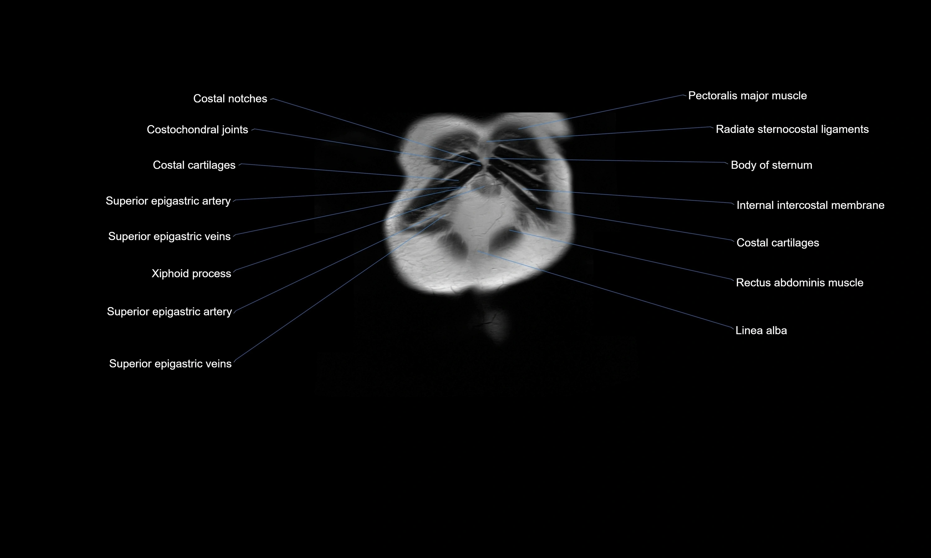MRI Abdomen axial cross sectional anatomy radiology  image-img-00001-00005.webp